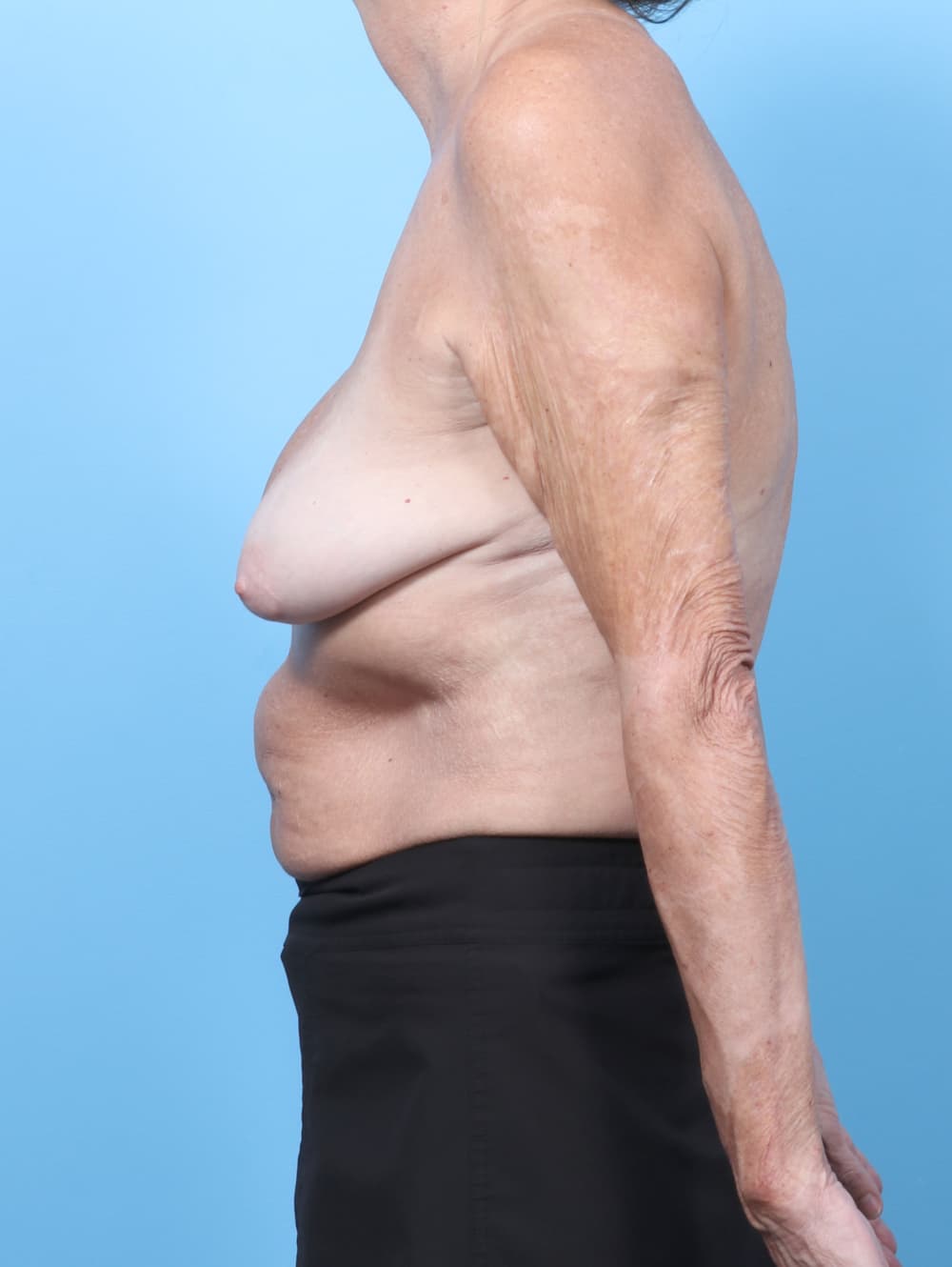 Breast Implant Revision case #9018 before, image 3