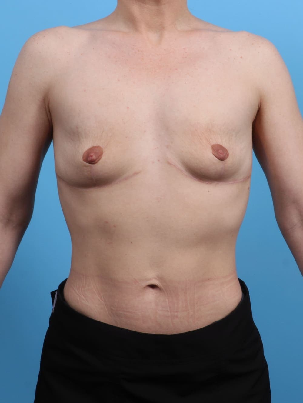 Breast Implant Removal with Lift case #3526 after