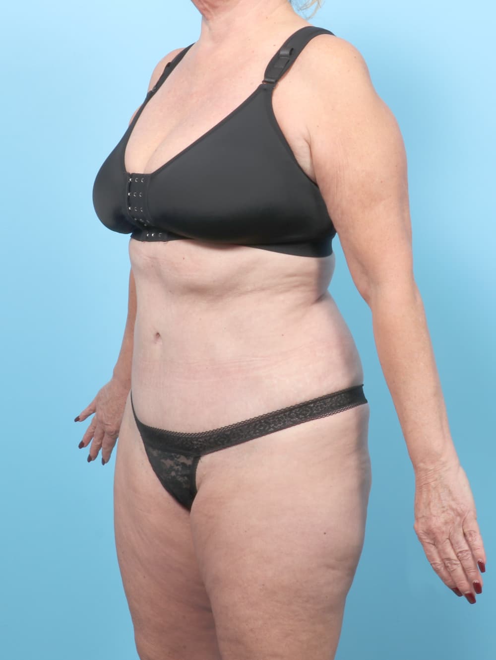 Tummy Tuck case #7461 after, image 2