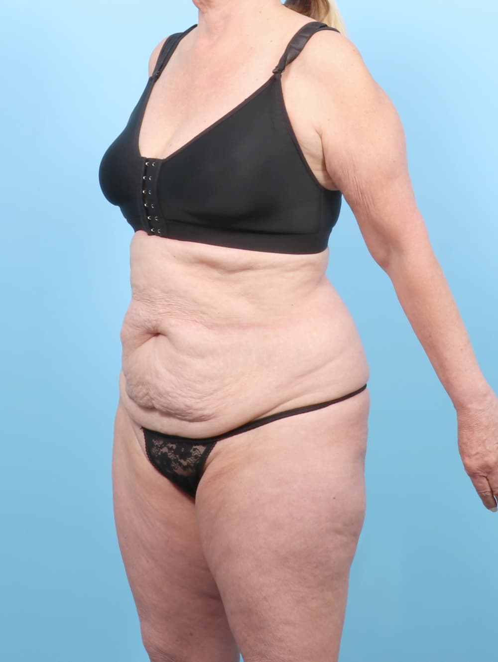 Tummy Tuck case #7461 before, image 2