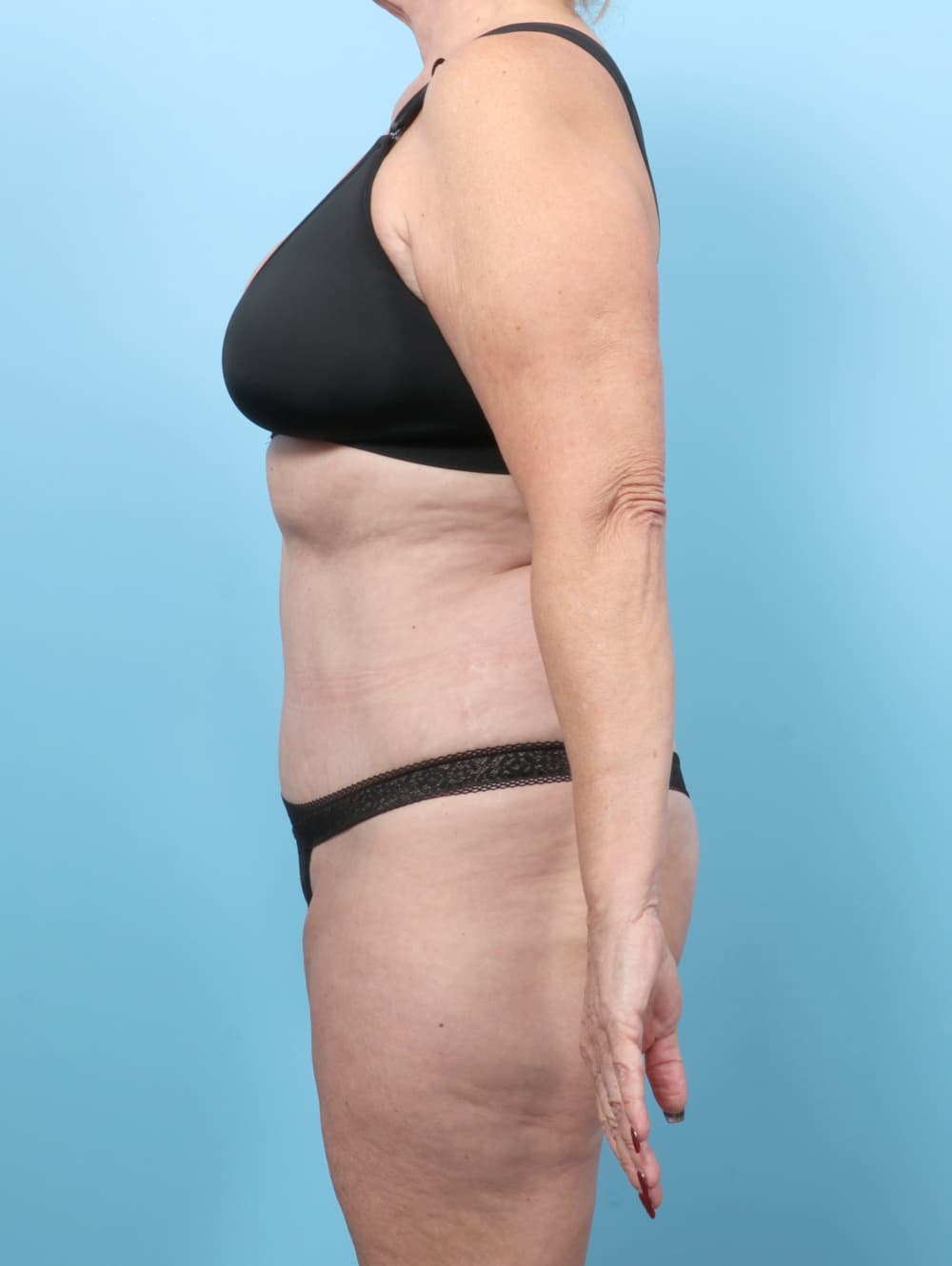Tummy Tuck case #7461 after, image 3