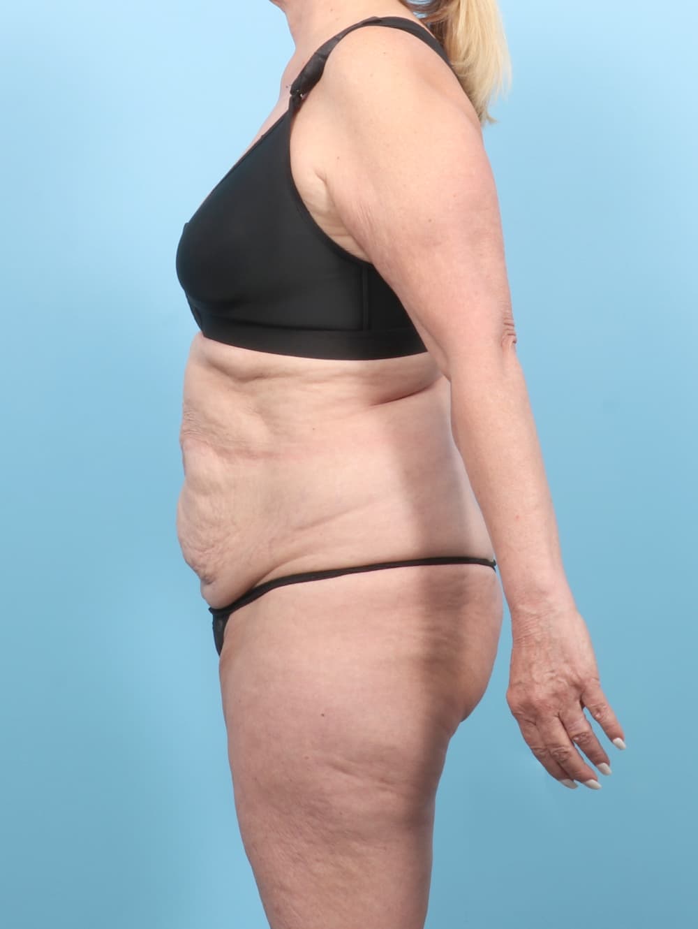 Tummy Tuck case #7461 before, image 3