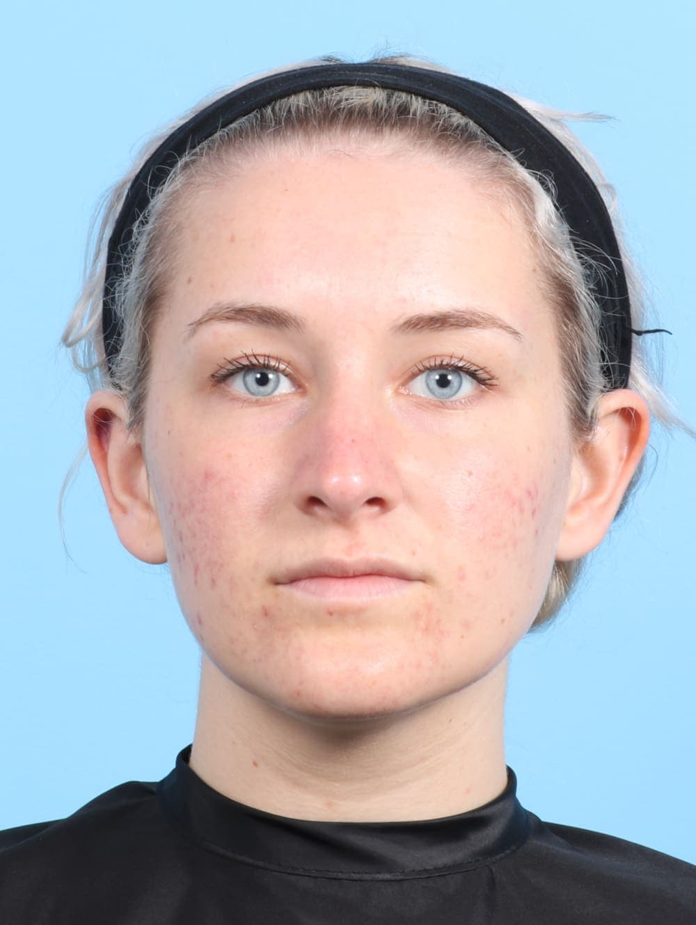 Rhinoplasty case #2585 after, image 2