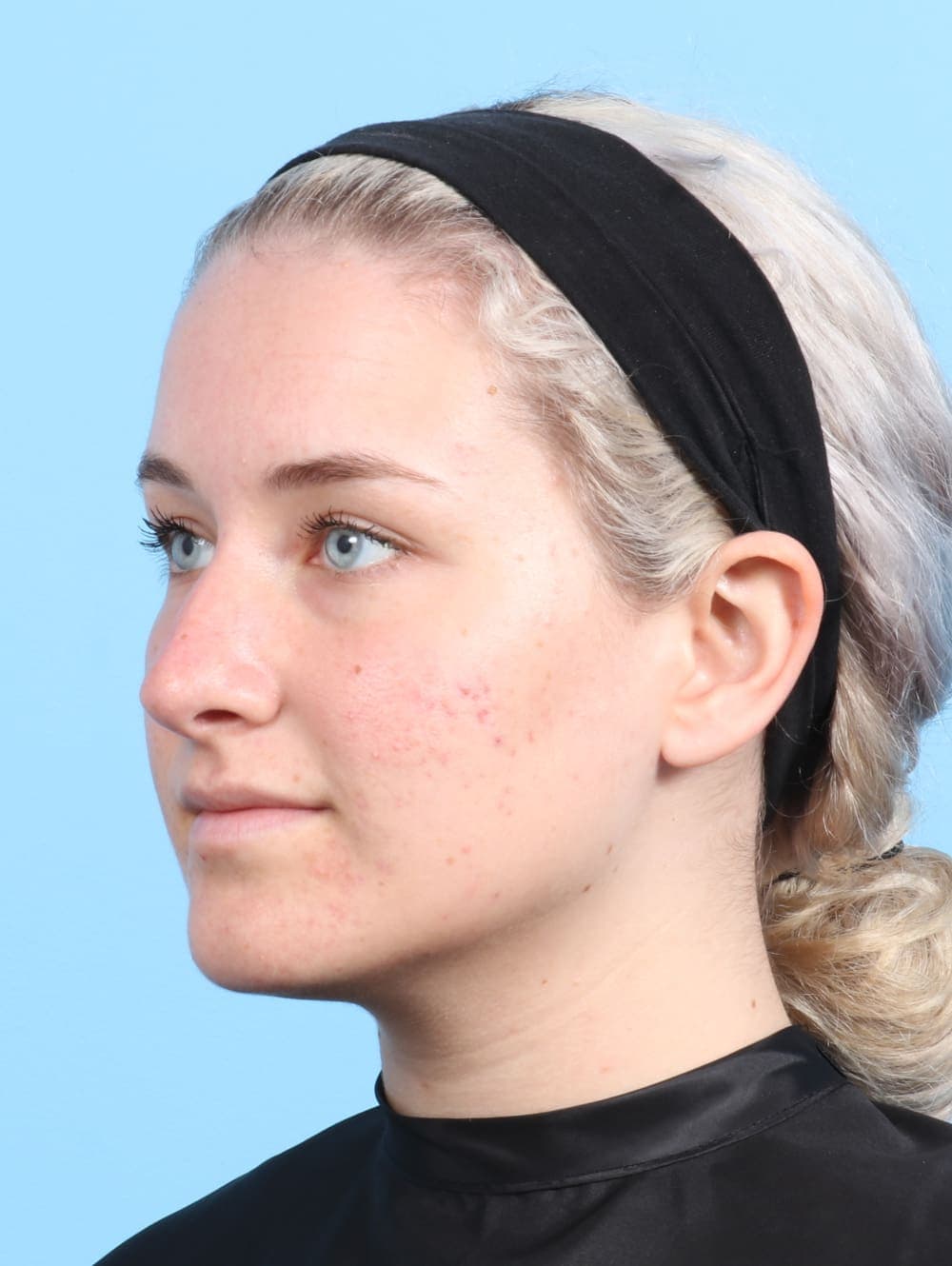 Rhinoplasty case #2585 after, image 3