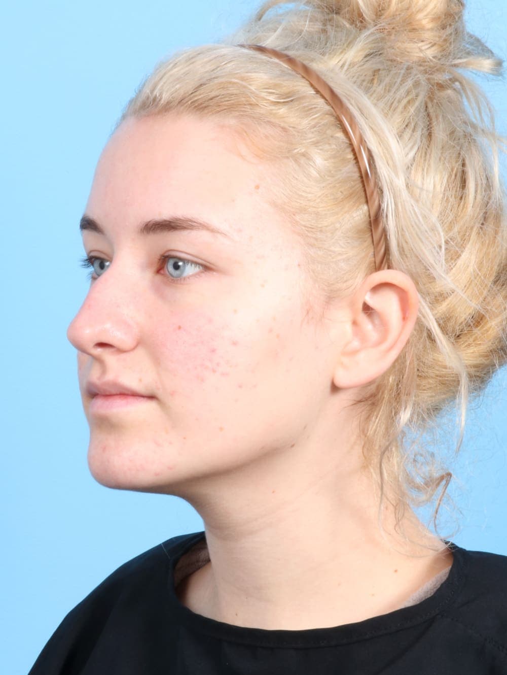 Rhinoplasty case #2585 before, image 3