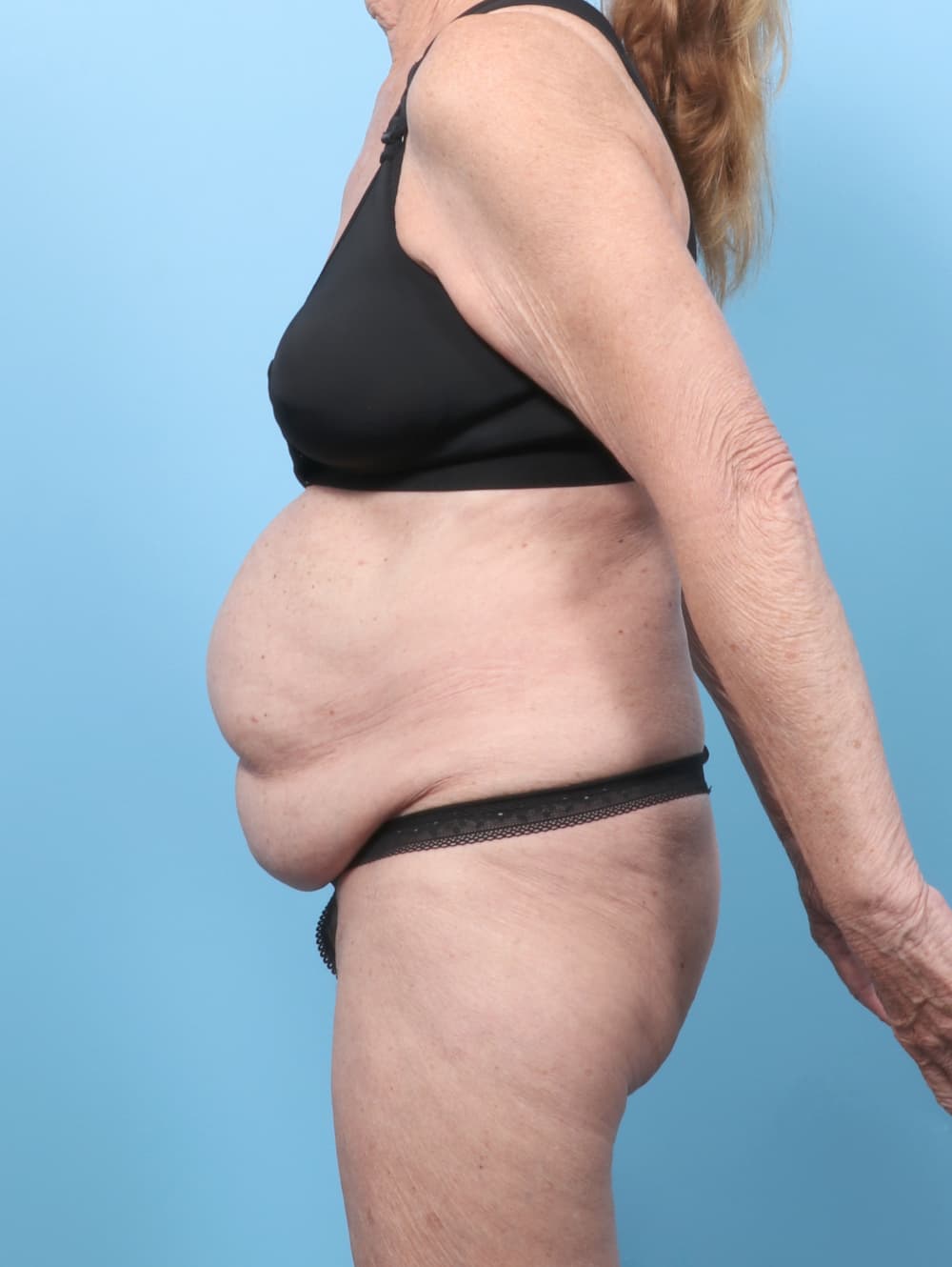 Tummy Tuck case #9013 before, image 3