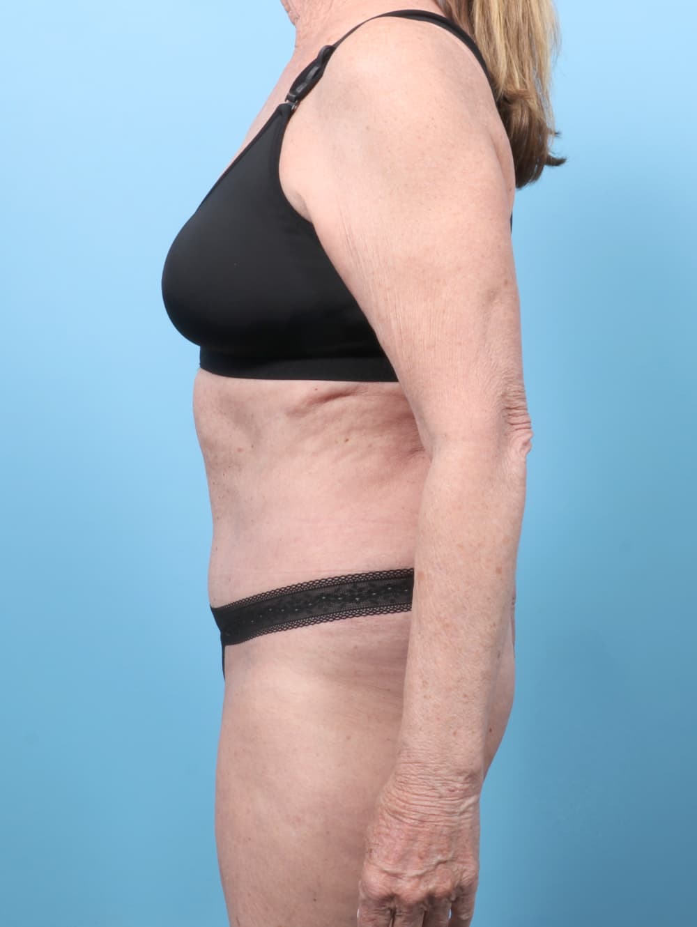 Tummy Tuck case #9013 after, image 3