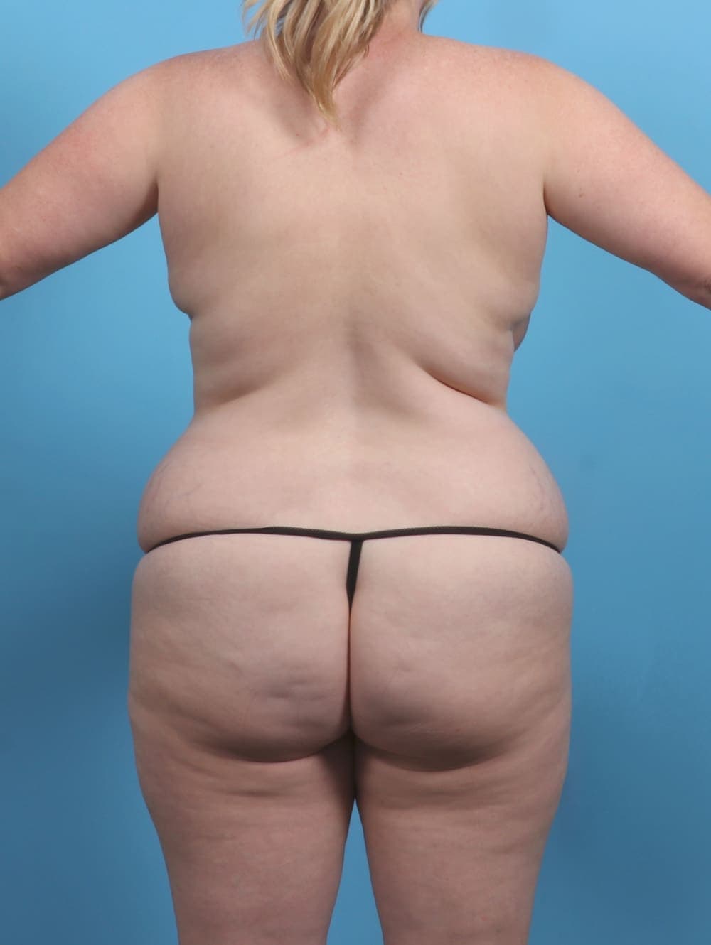 Liposuction case #5092 before, image 4