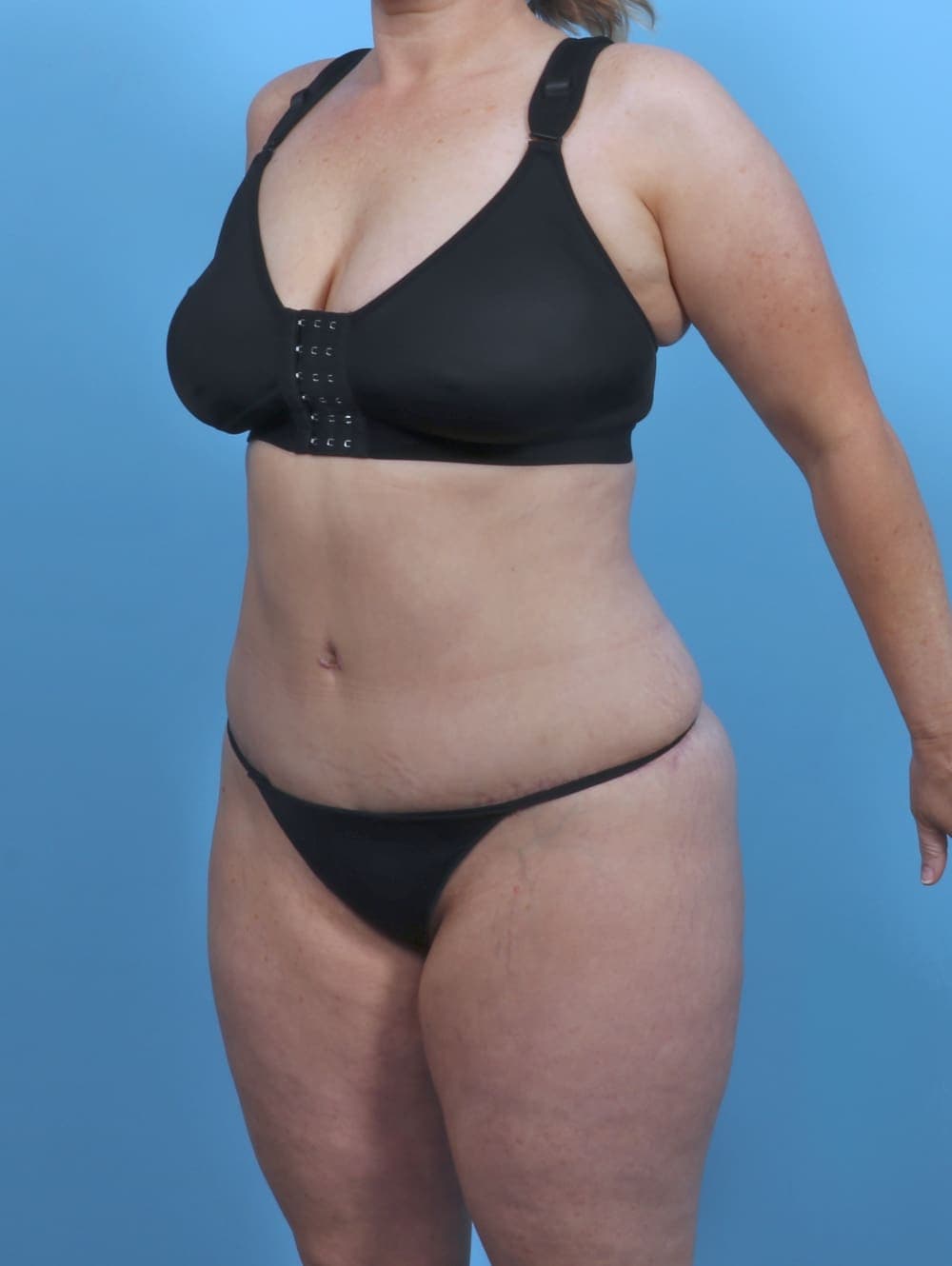 Liposuction case #5092 after, image 2