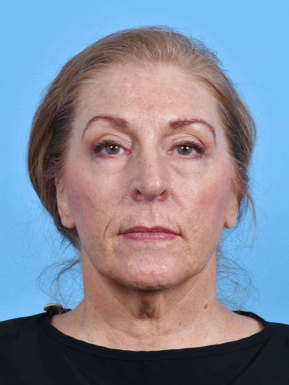 Facelift case #3641 before