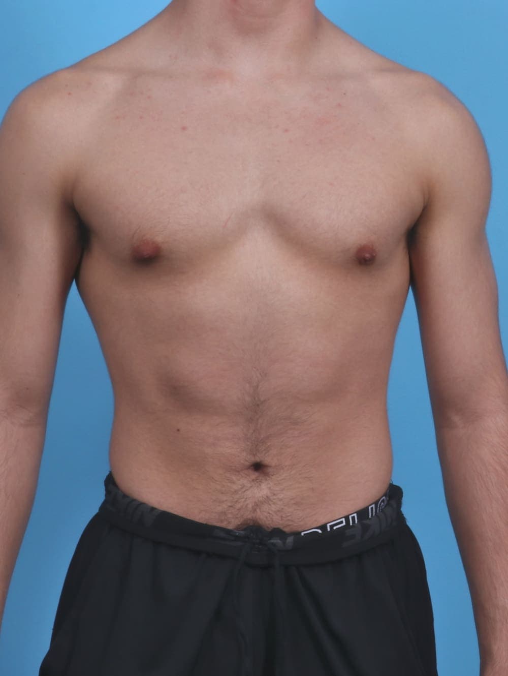 Male Breast Reduction case #3906 after