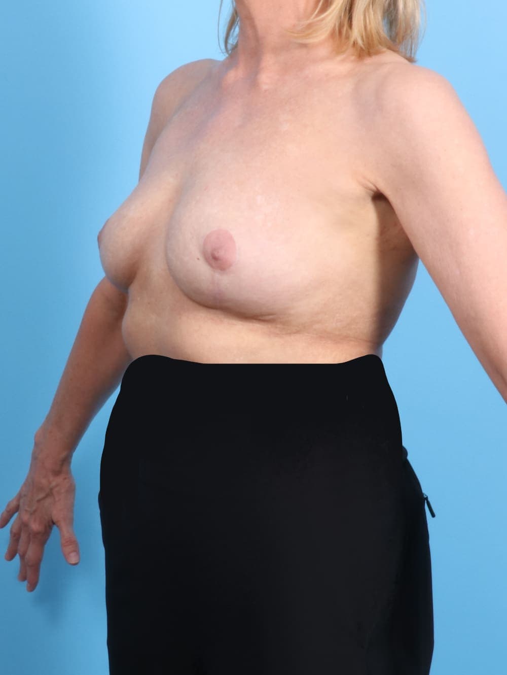 Breast Implant Revision case #1949 after, image 2