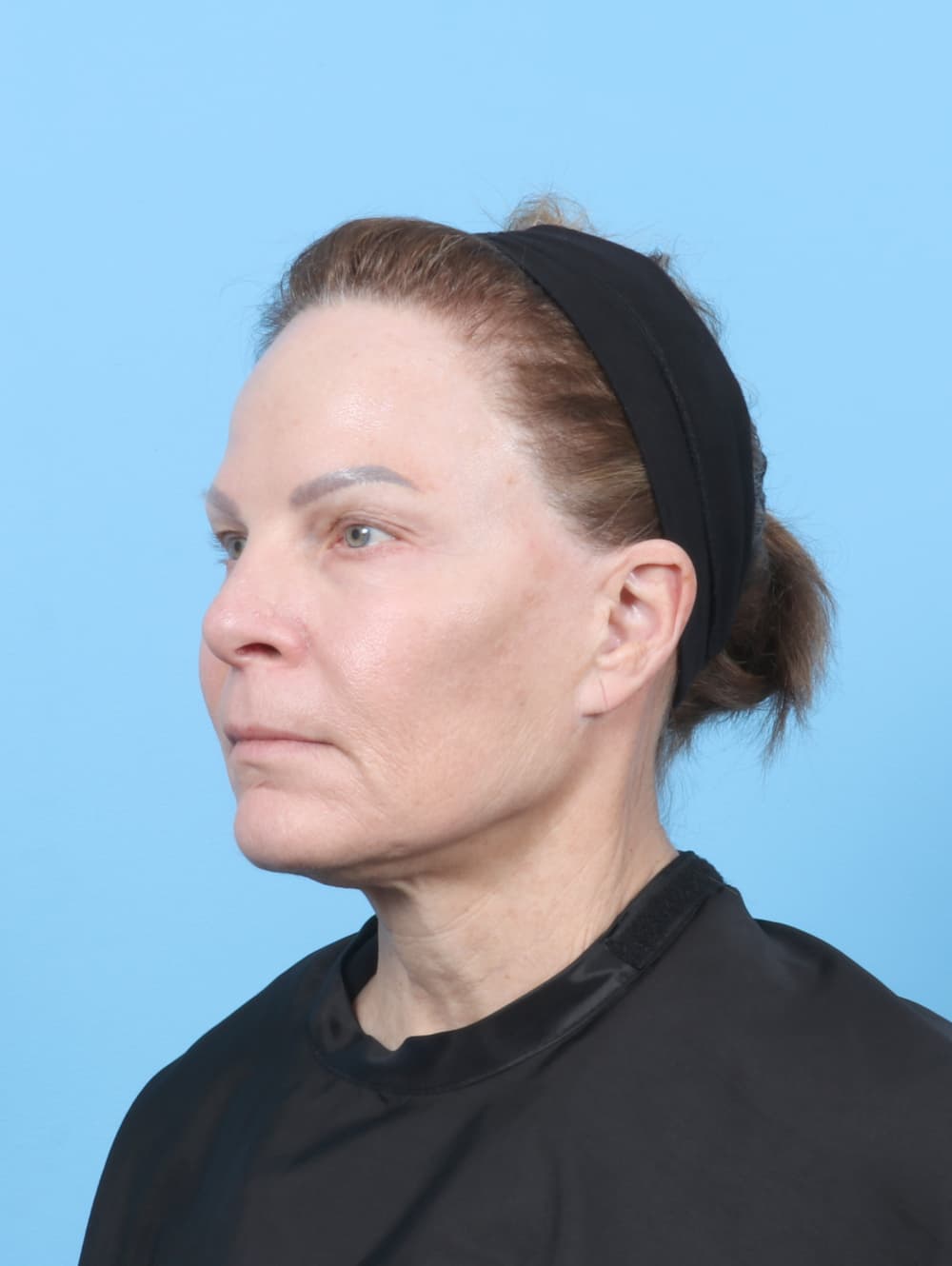 Eyelid Surgery case #7339 before, image 2