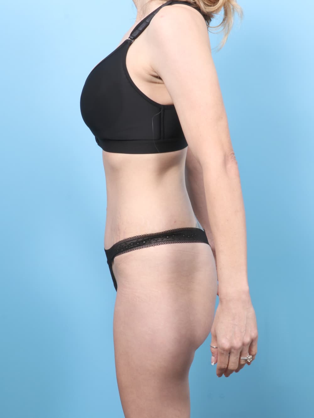 Tummy Tuck case #9030 after, image 3