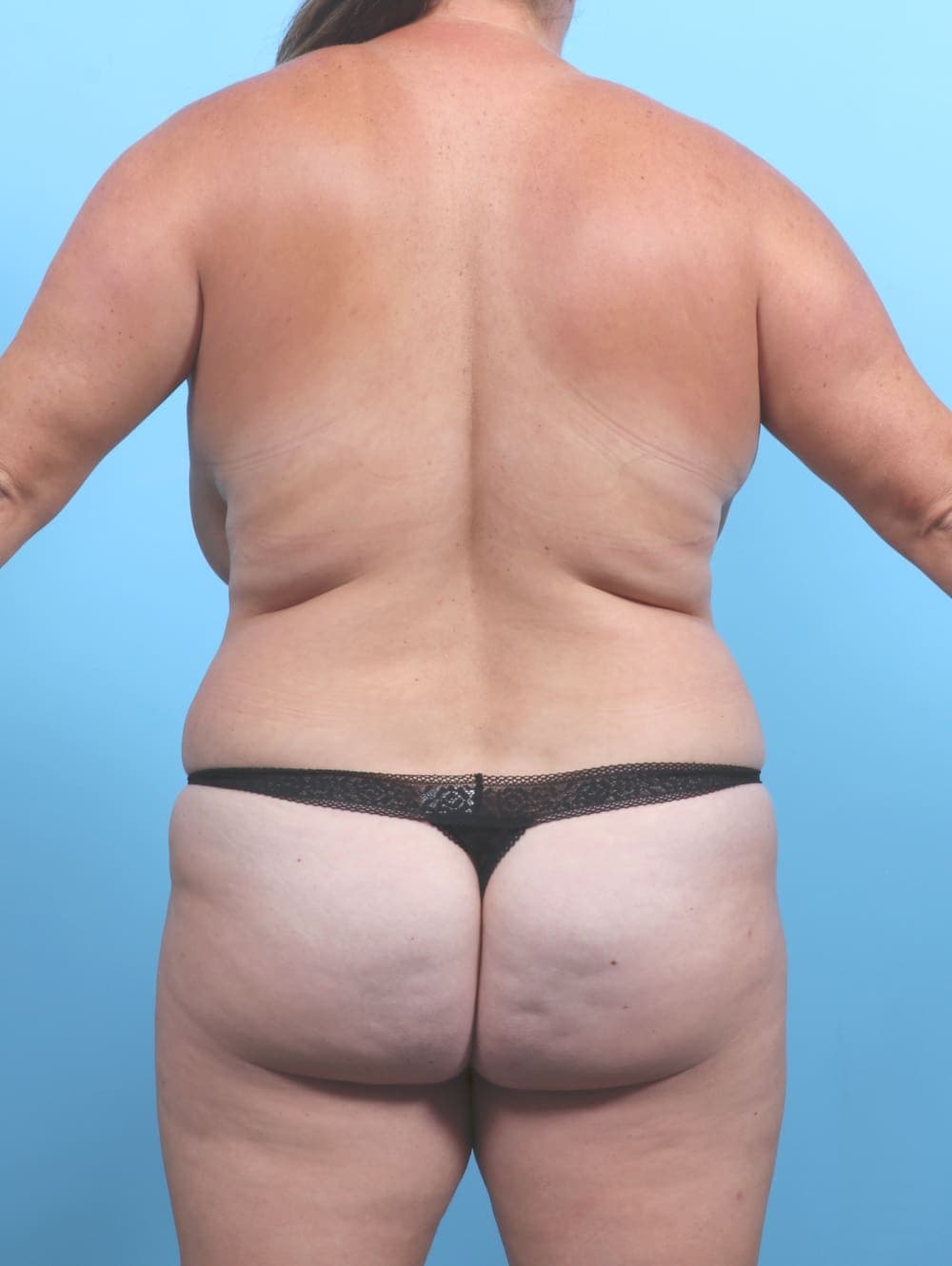 Liposuction case #6479 before, image 2