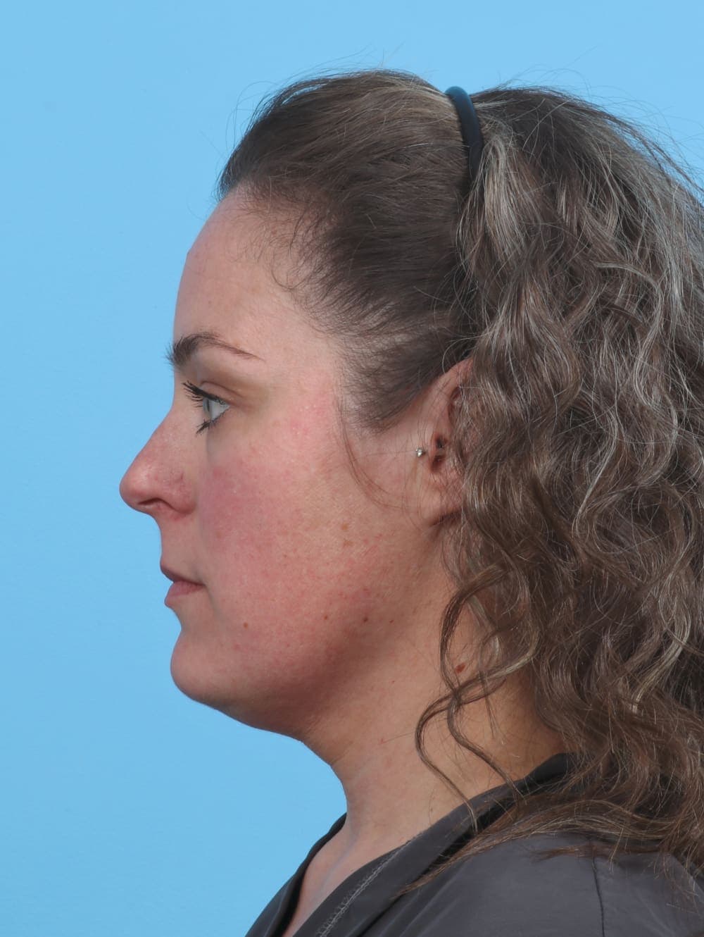 Facial Liposuction case #3975 before, image 3