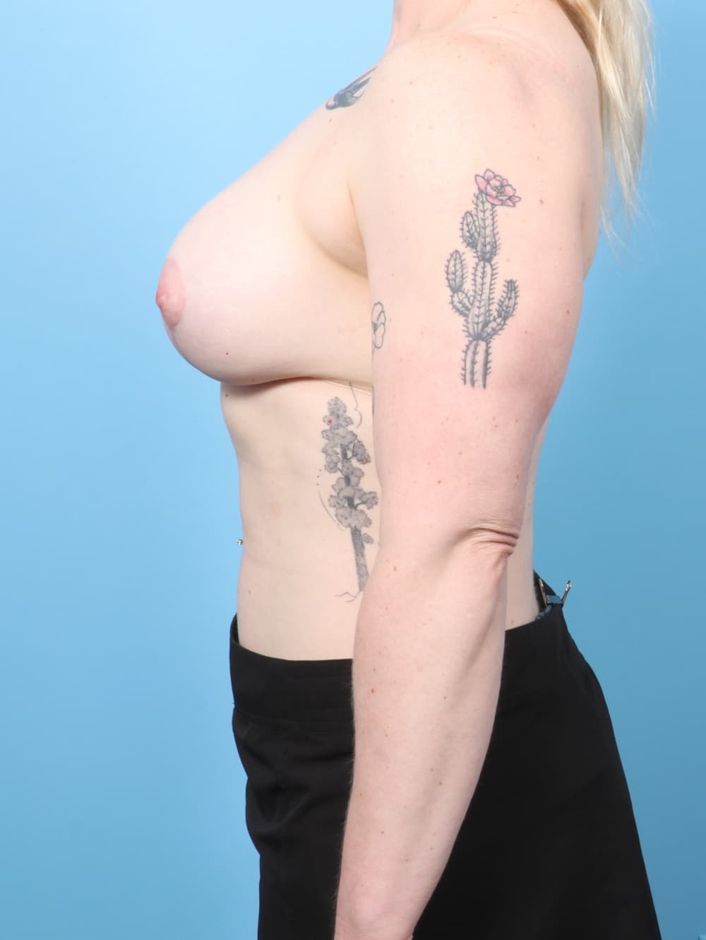 Breast Lift with Implants case #8990 after, image 3