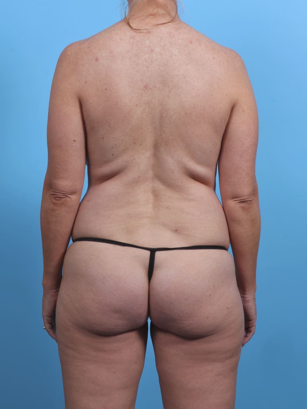 Mommy Makeover case #4219 before, image 4