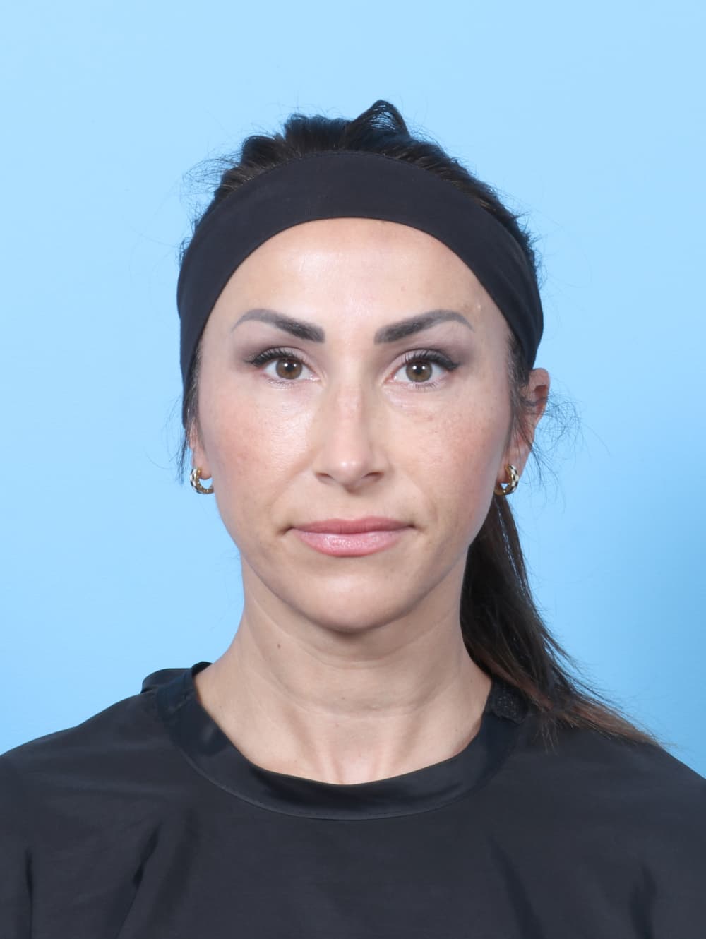Rhinoplasty case #8153 after, image 2