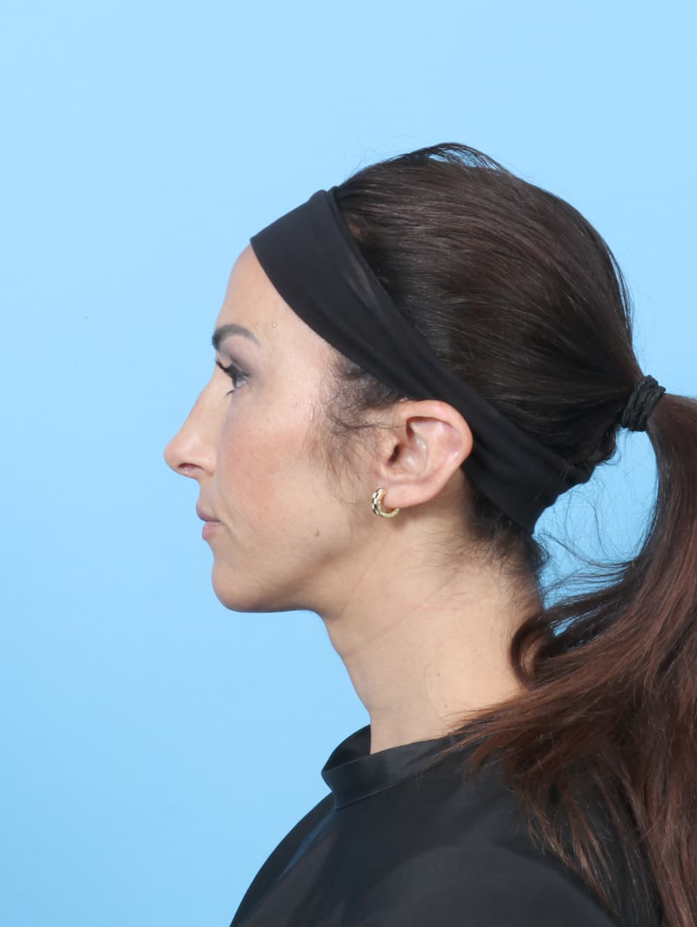 Rhinoplasty case #8153 after