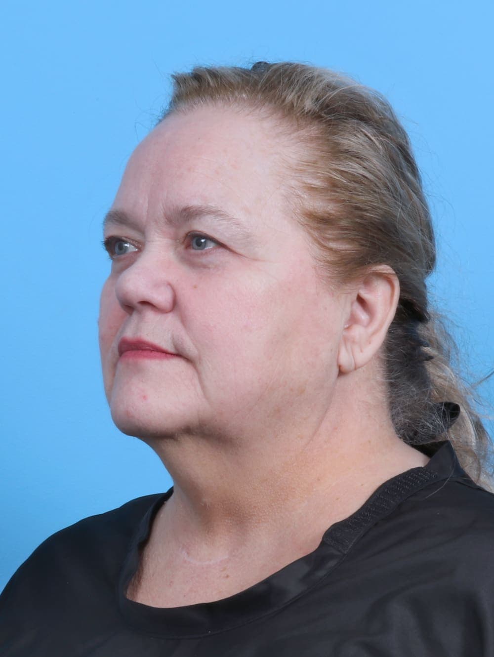 Facelift case #5668 before, image 2