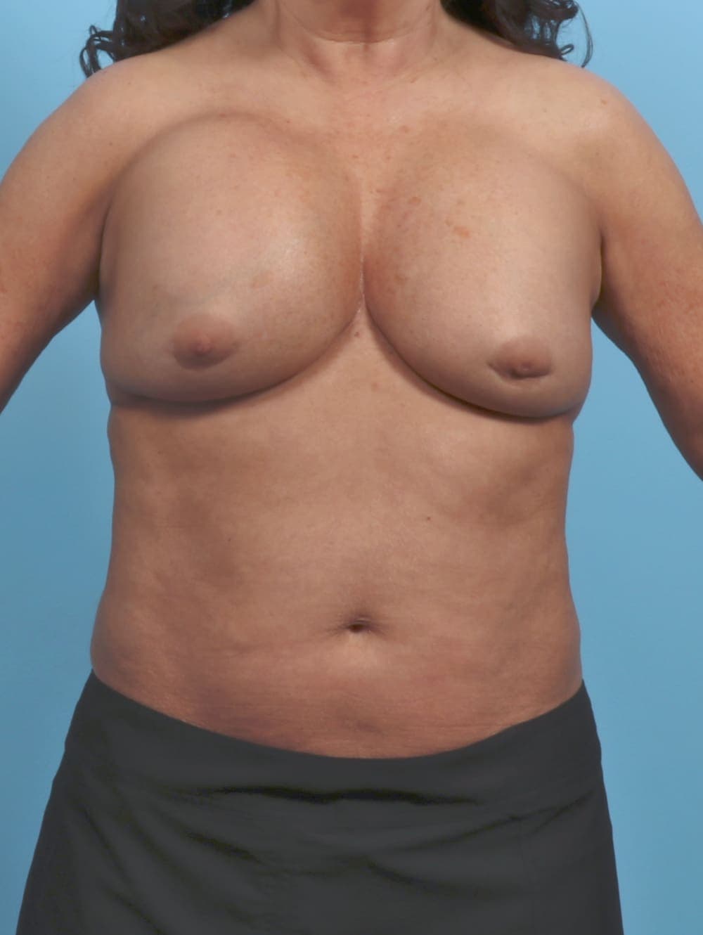 Breast Implant Revision case #5359 before