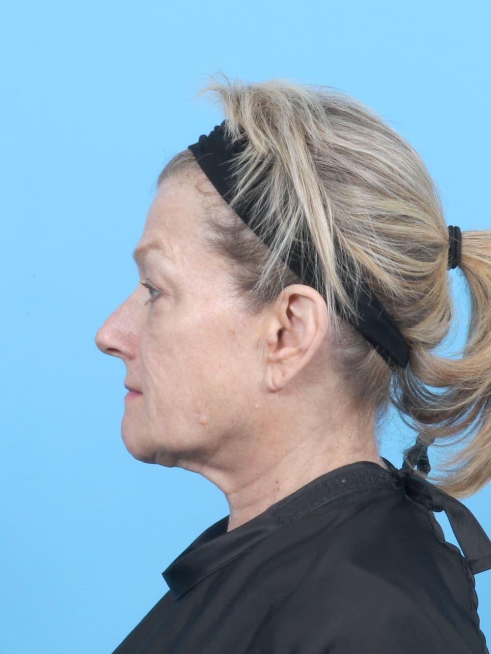 Eyelid Surgery case #6895 before, image 3