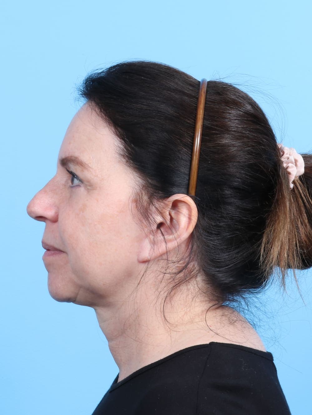Facelift case #2266 after, image 3