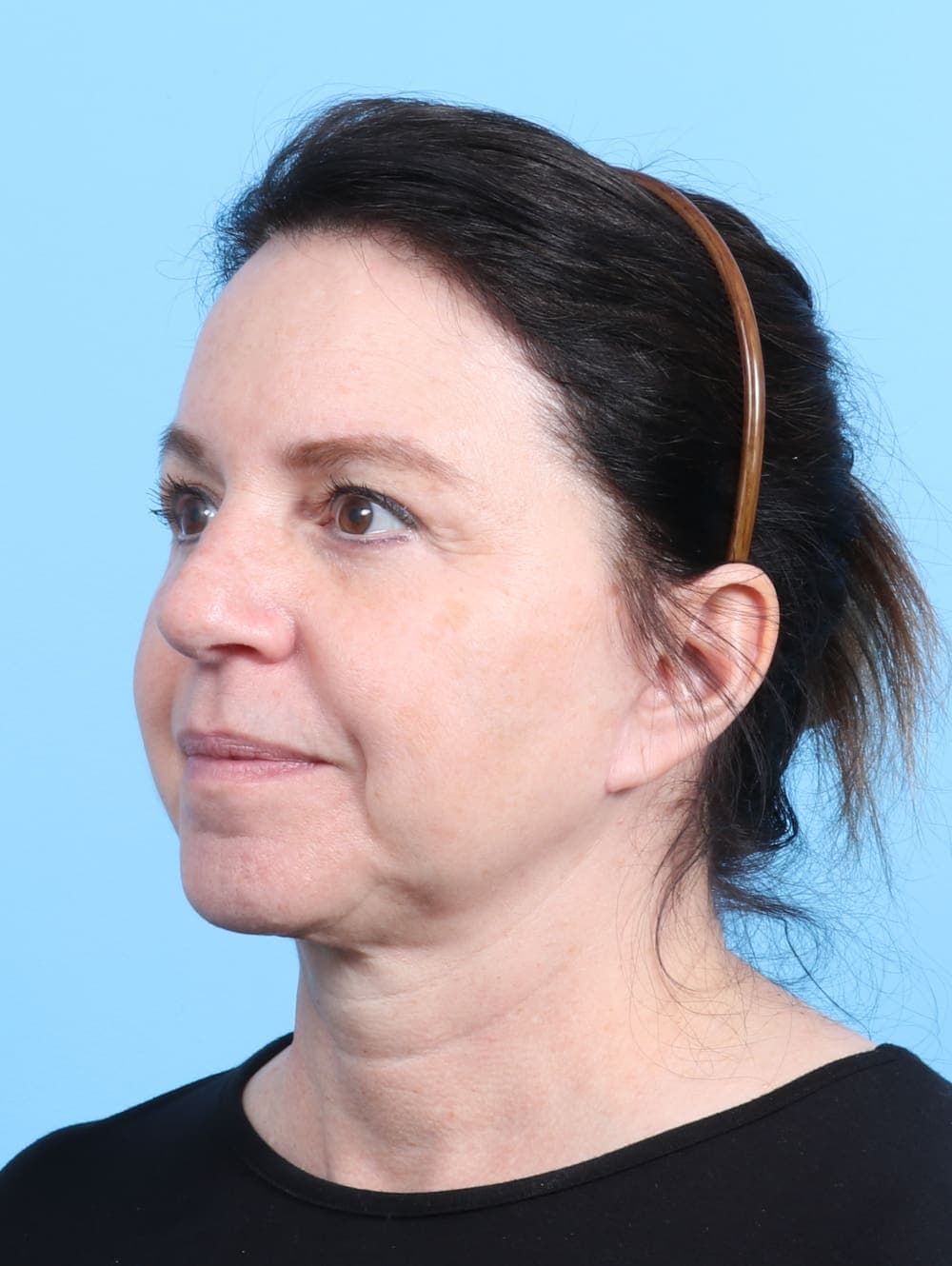 Facelift case #2266 after, image 2