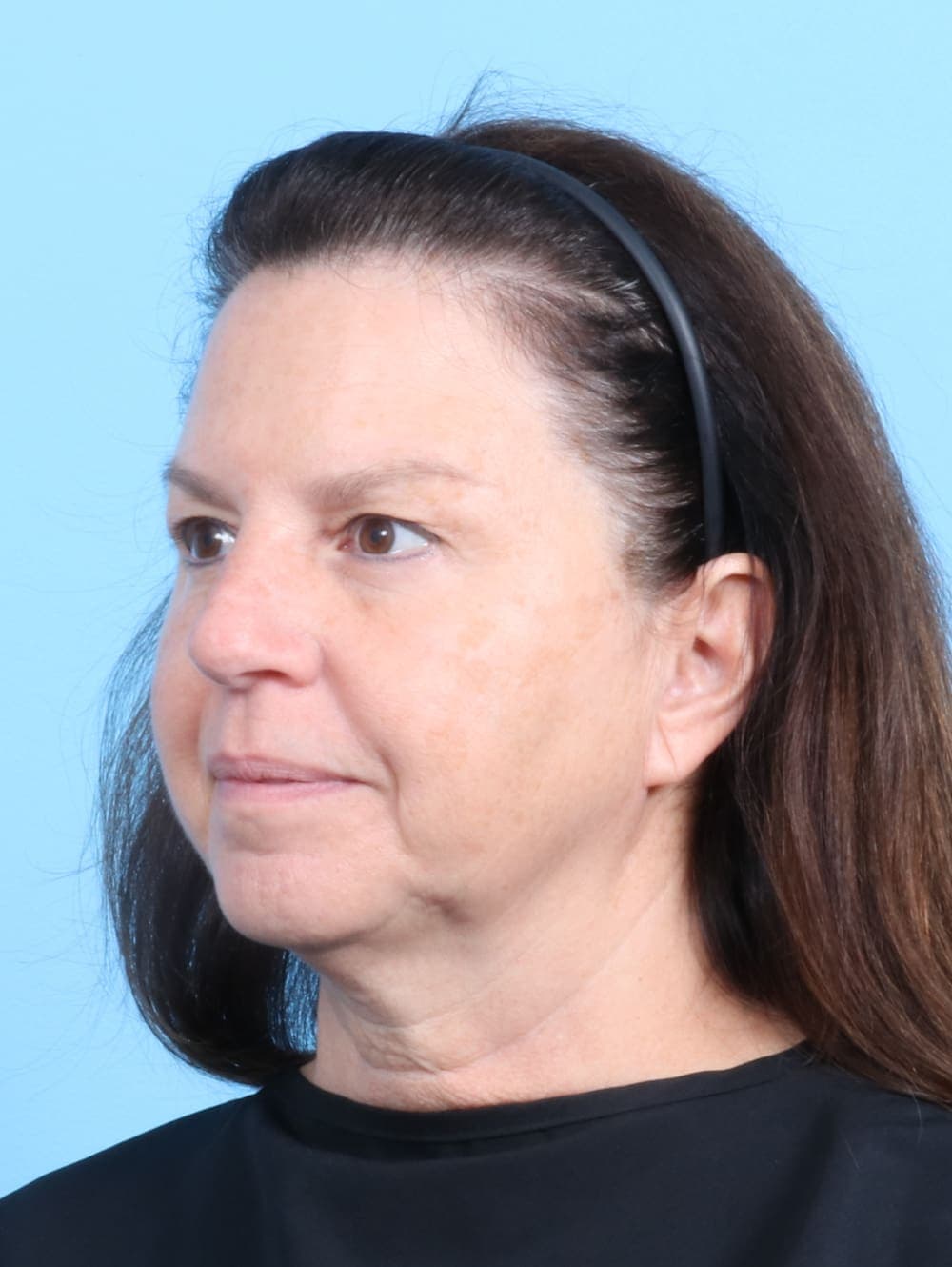 Facelift case #2266 before, image 2