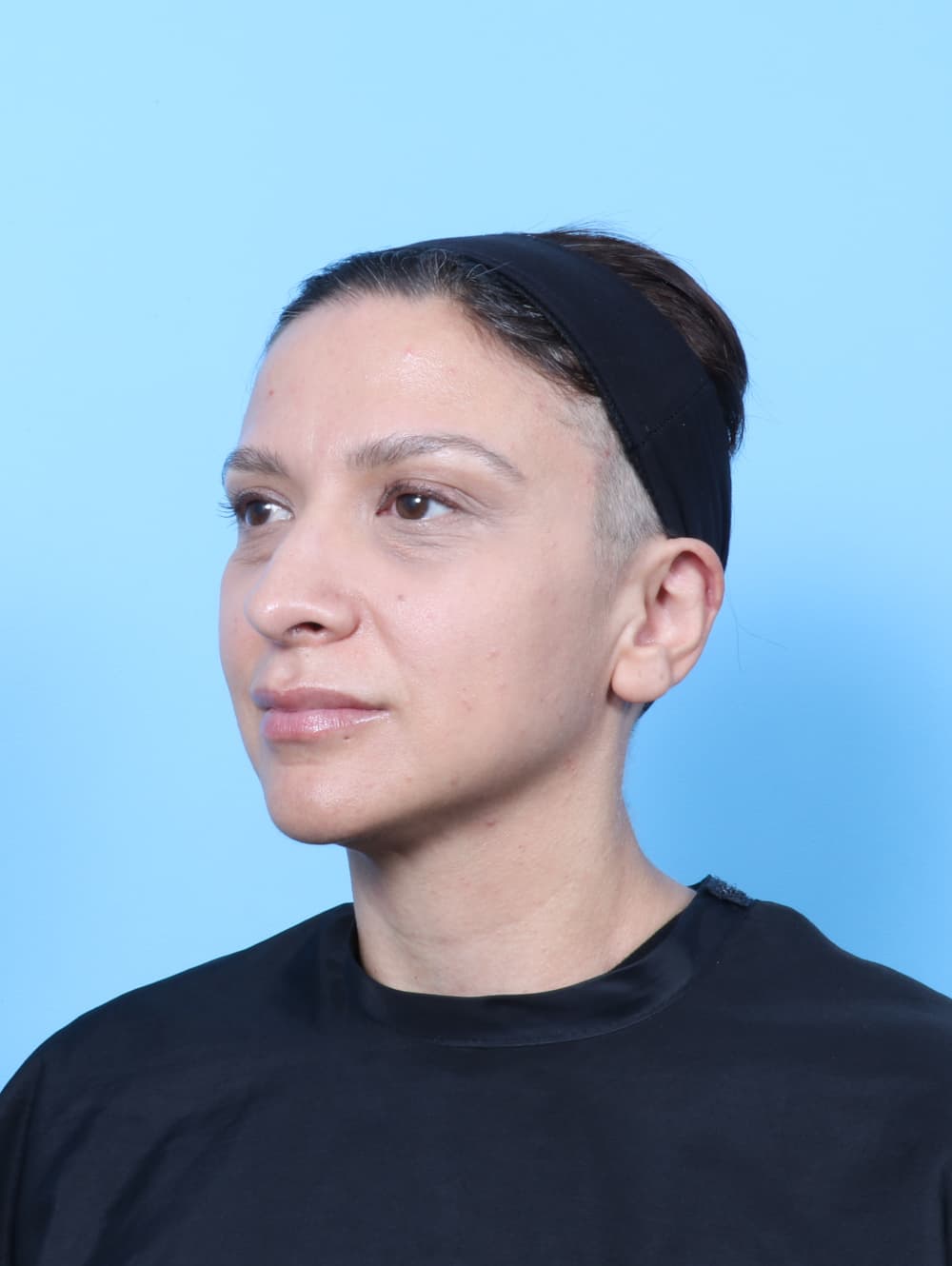 Rhinoplasty case #9034 after, image 3