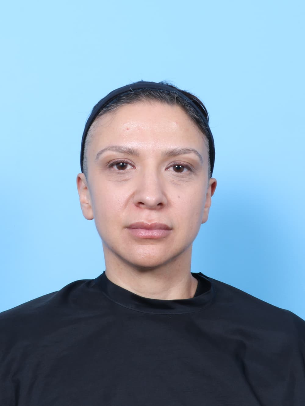 Rhinoplasty case #9034 after, image 2