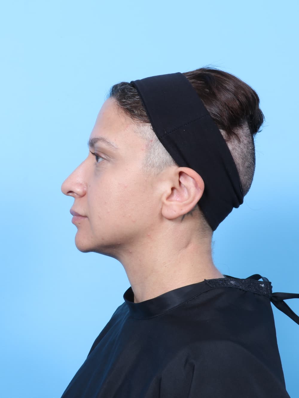 Rhinoplasty case #9034 after, image 1