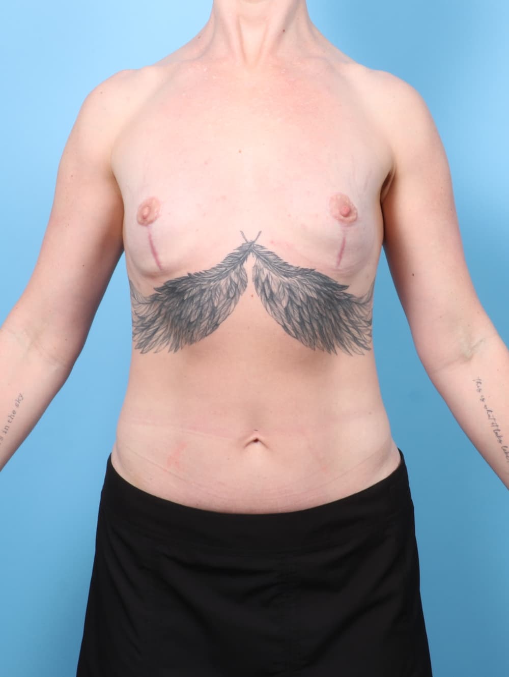 Breast Implant Removal with Lift case #7815 after