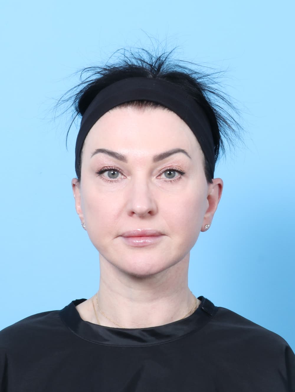 Facelift case #9004 after, image 1