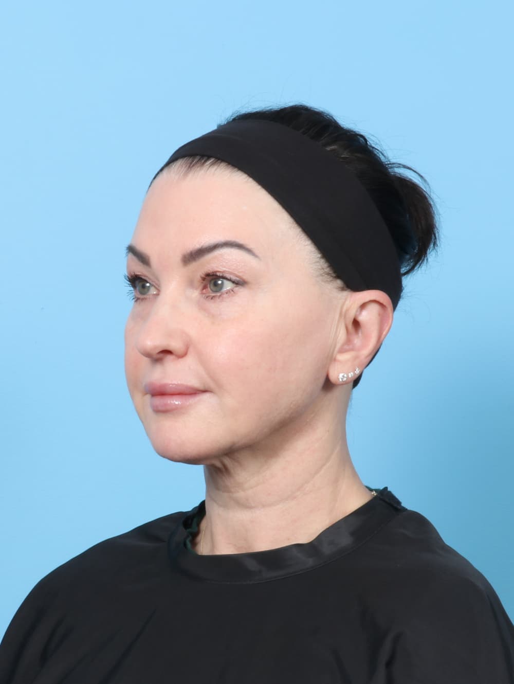 Facelift case #9004 before, image 3