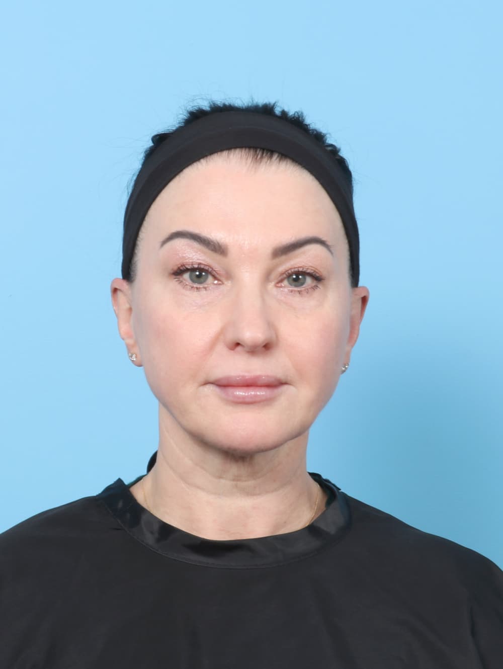 Facelift case #9004 before, image 1