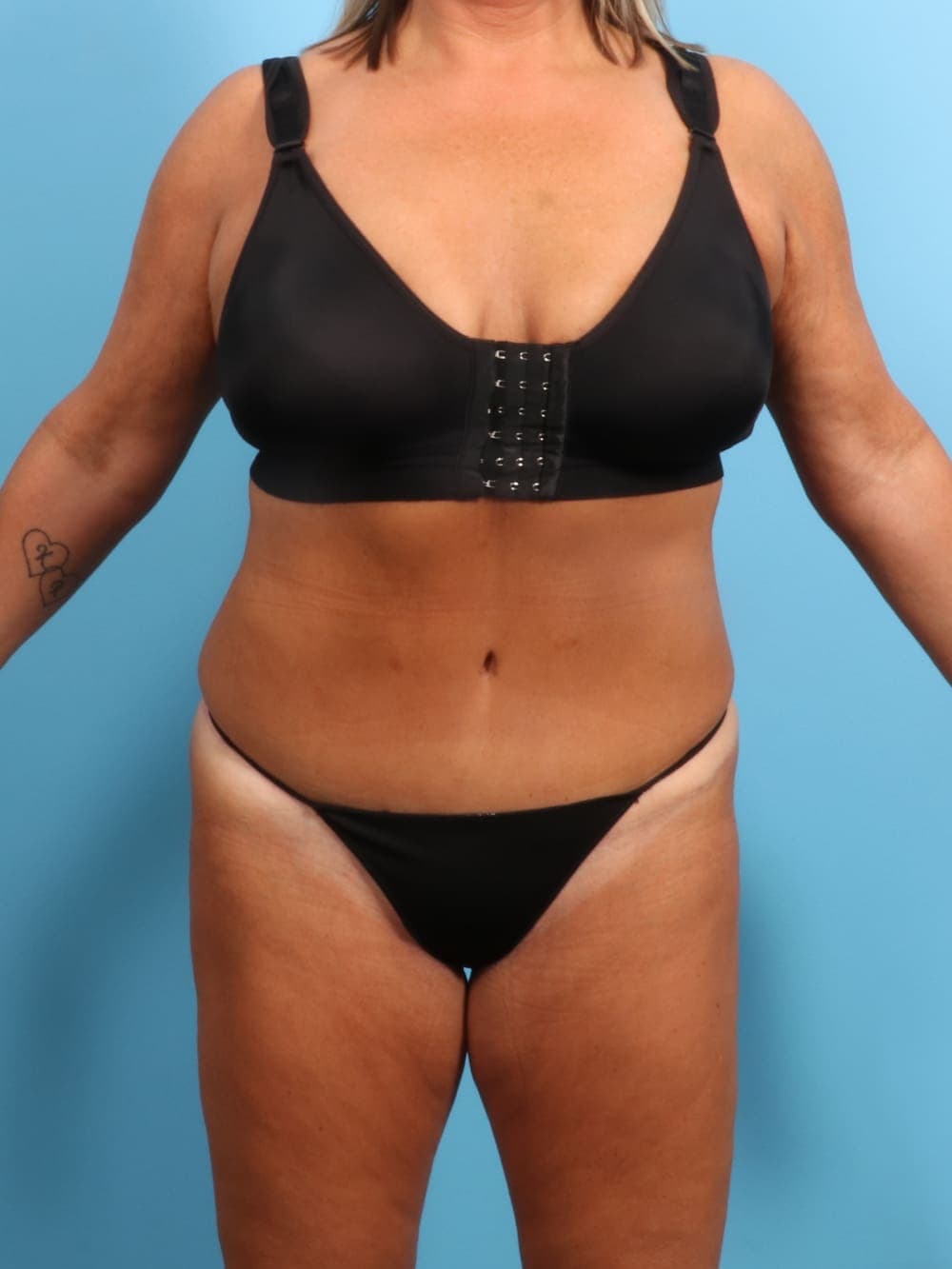 Tummy Tuck case #1722 after, image 1