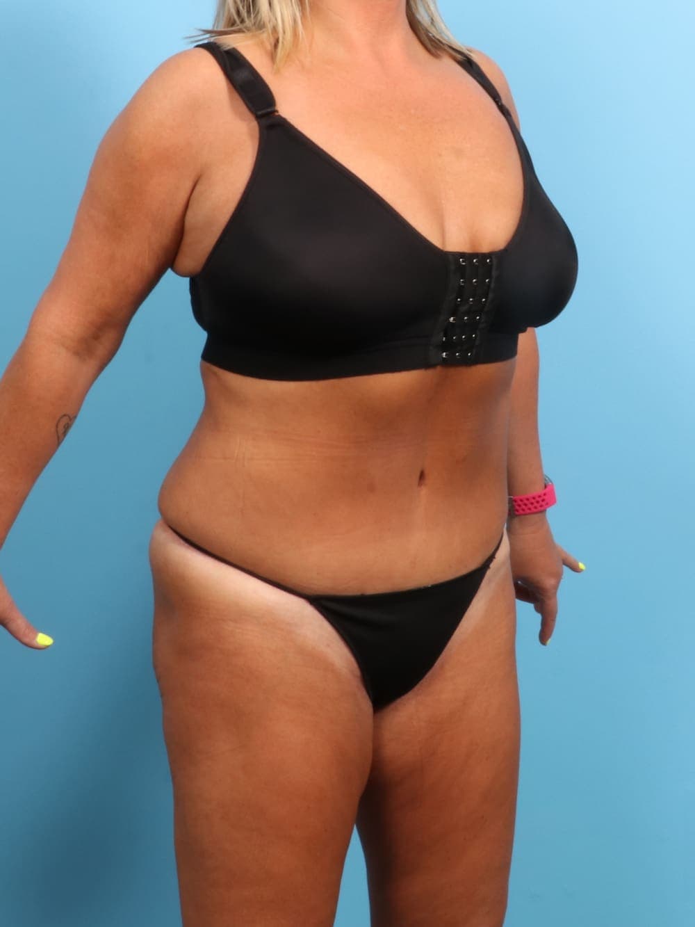 Tummy Tuck case #1722 after, image 2