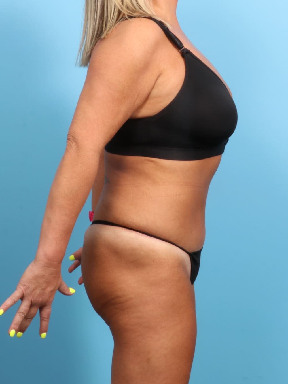 Tummy Tuck case #1722 after, image 3