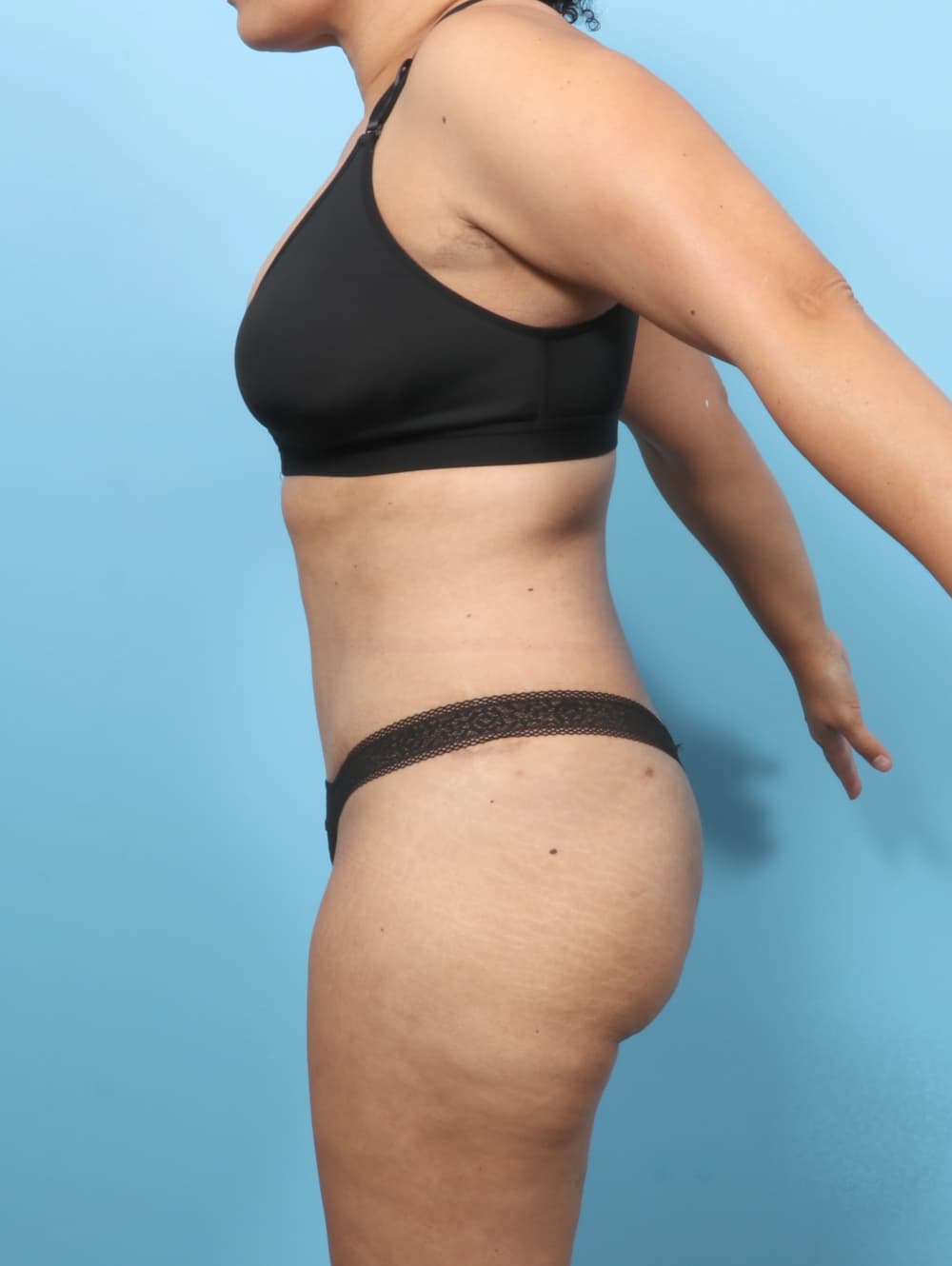 Liposuction case #7574 after, image 3