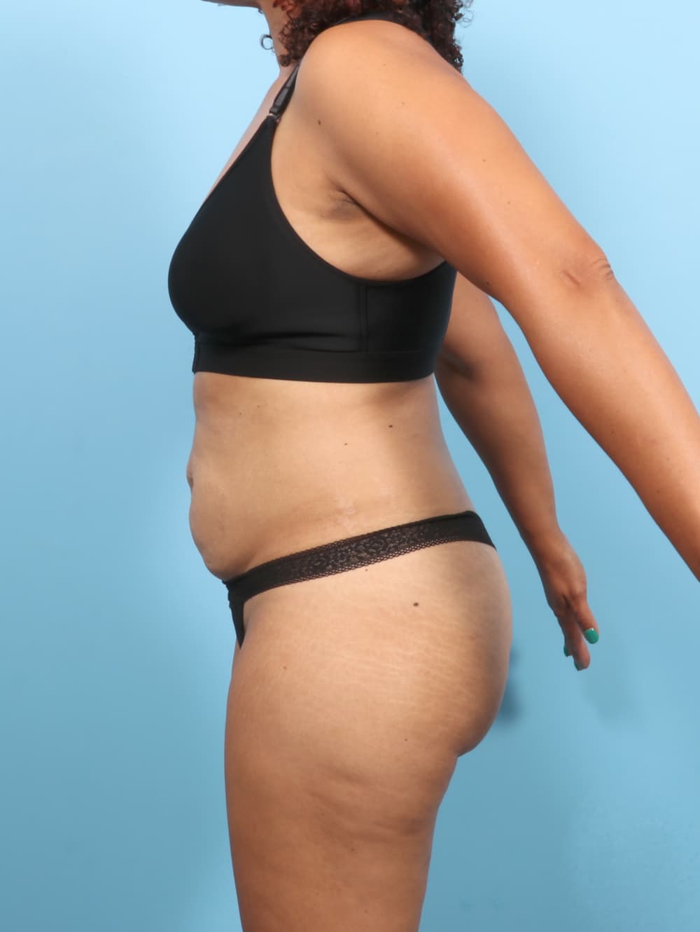 Liposuction case #7574 before, image 3