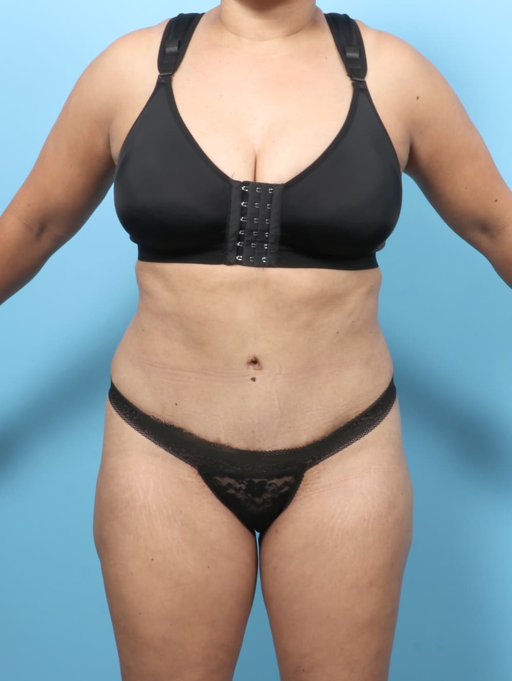 Tummy Tuck case #7574 after