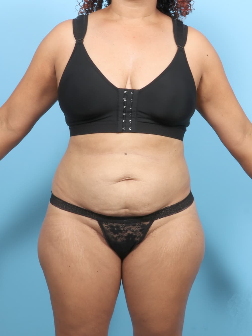 Tummy Tuck case #7574 before