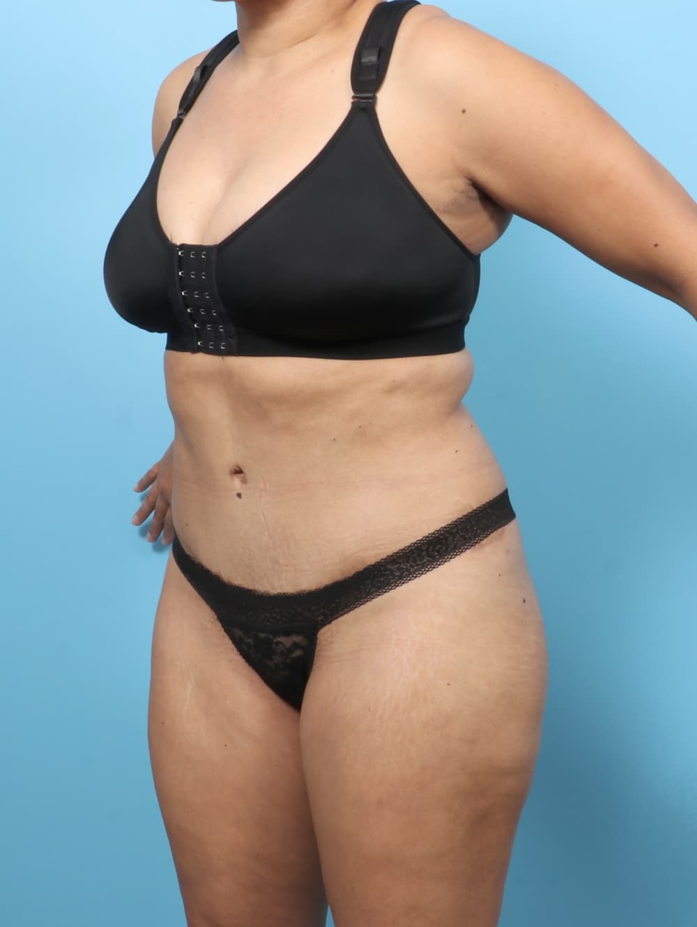 Liposuction case #7574 after, image 2