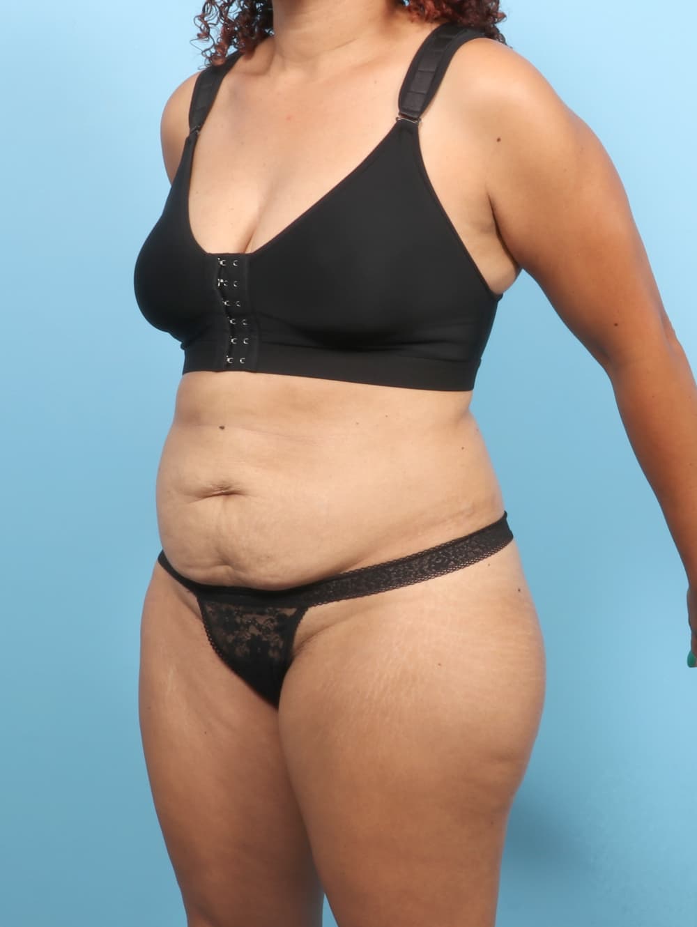 Liposuction case #7574 before, image 2