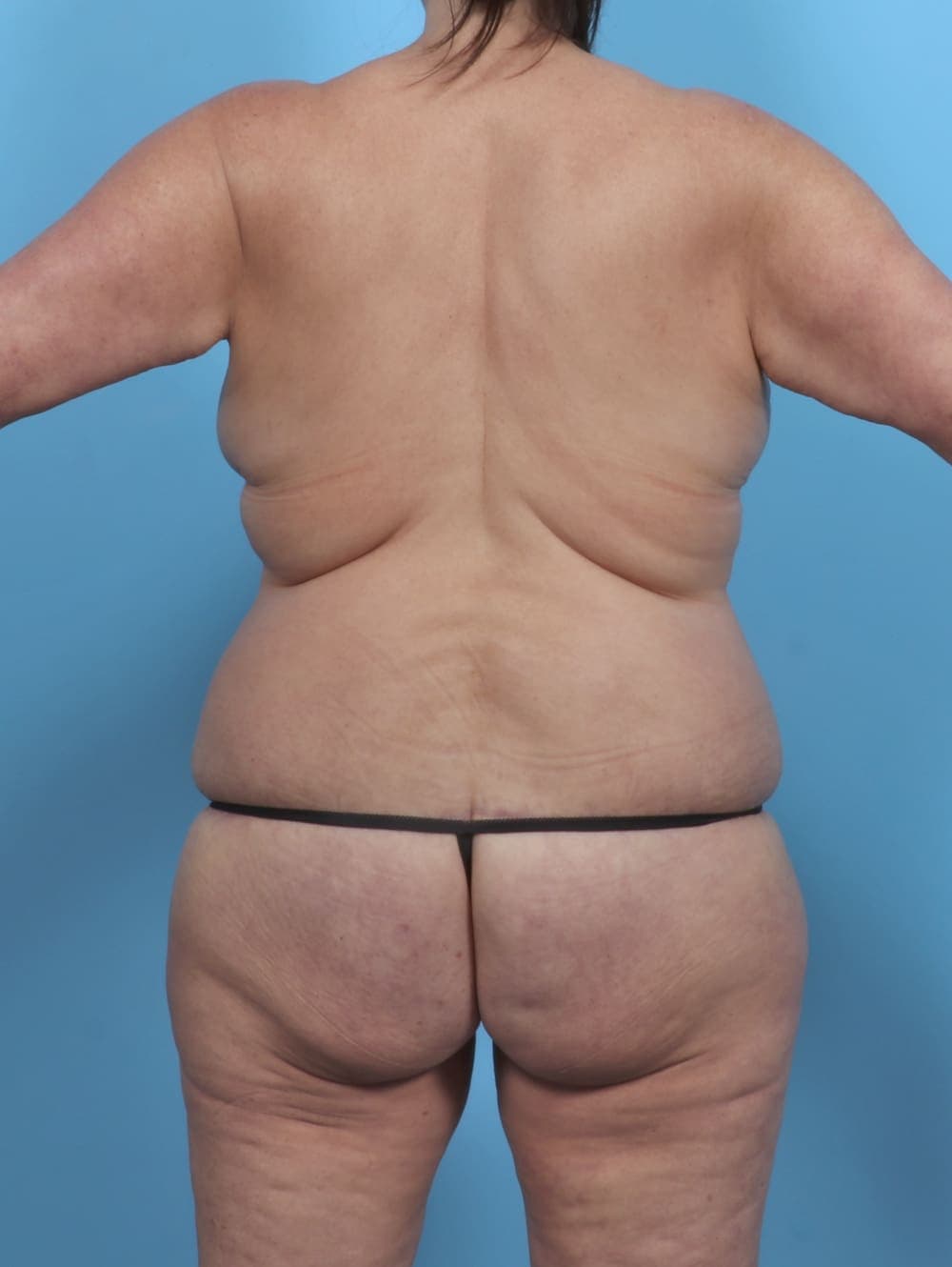 Body Lift case #5375 after, image 3