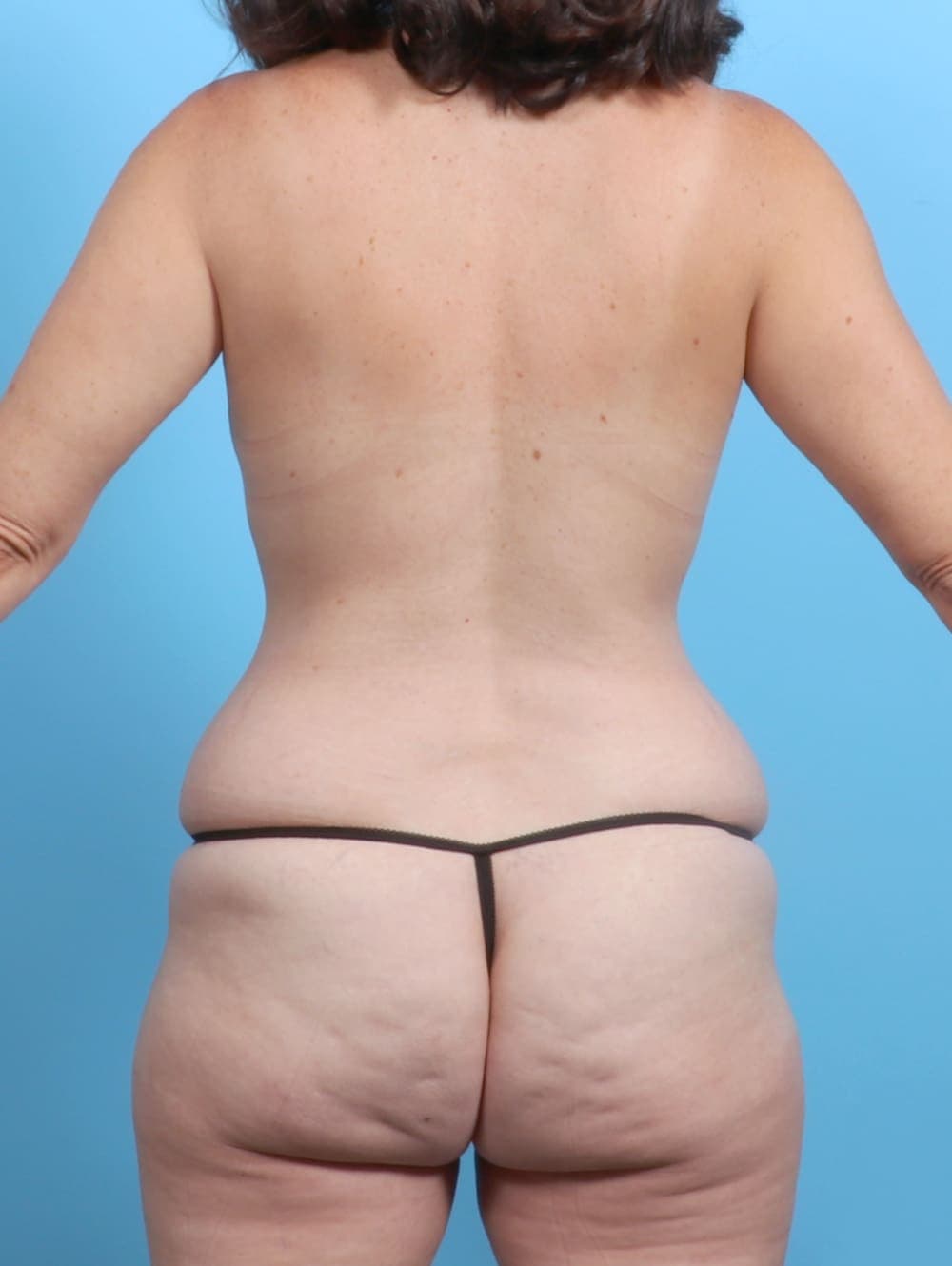 Tummy Tuck case #6555 before, image 2