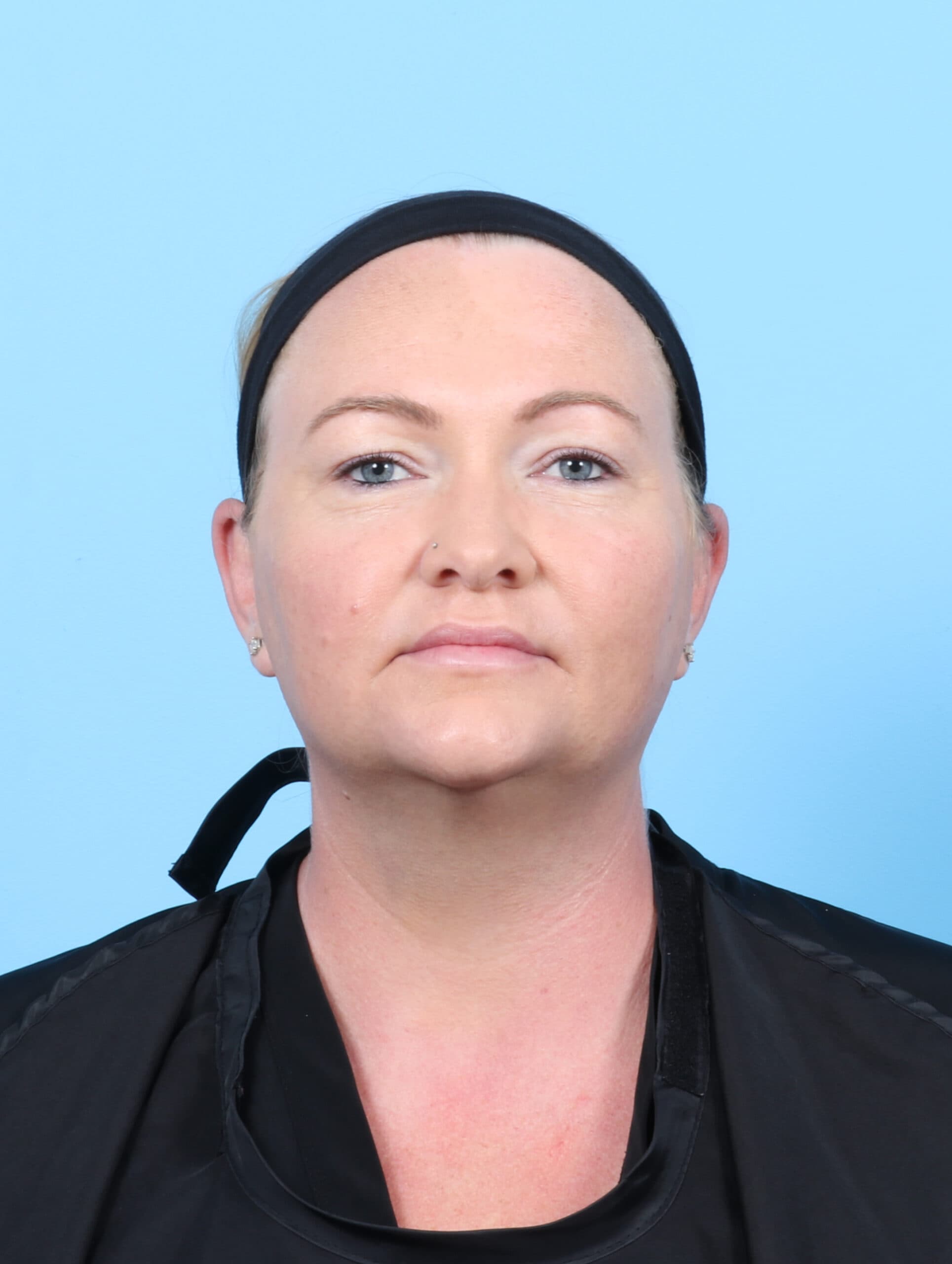 Facial Surgery case #6998 after