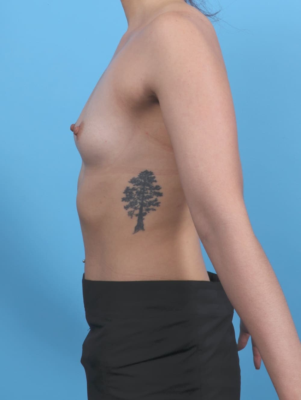 Breast Augmentation case #6010 before, image 3